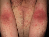 Kollarda Kaşıntı Belirtileri ve Tedavisi Kollarda Kaşıntı Belirtileri ve Tedavisi