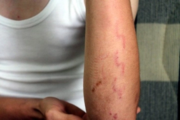 Çatlak Kol Belirtileri ve Tedavisi Çatlak Kol Belirtileri ve Tedavisi